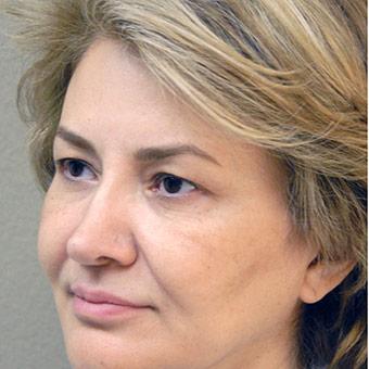 Blepharoplasty before and after - before