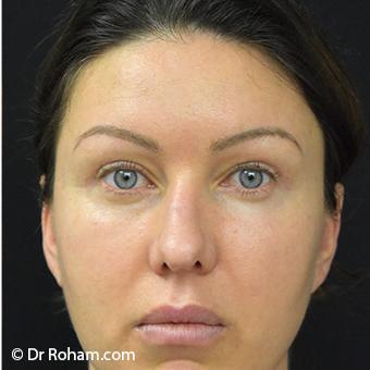 Blepharoplasty before and after - after