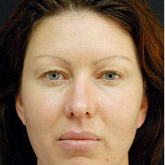 Blepharoplasty before and after - before