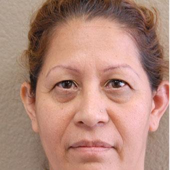 Blepharoplasty before and after - before