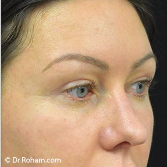 Blepharoplasty before and after - after