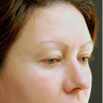 Blepharoplasty before and after - before