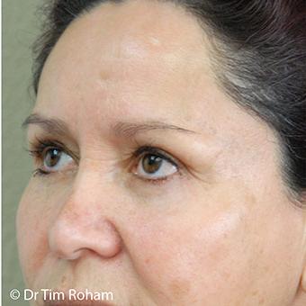Blepharoplasty before and after - after