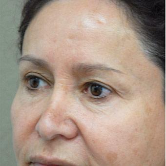 Blepharoplasty before and after - before