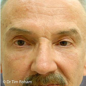 Blepharoplasty before and after - after
