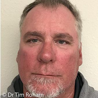 Blepharoplasty before and after - after
