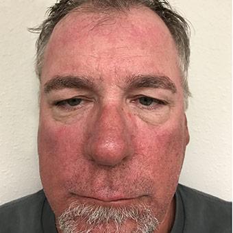 Blepharoplasty before and after - before