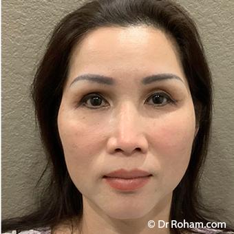 Blepharoplasty before and after - after