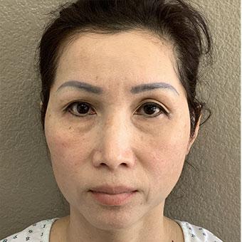 Blepharoplasty before and after - before