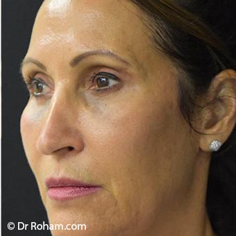 Blepharoplasty before and after - after