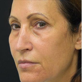 Blepharoplasty before and after - before