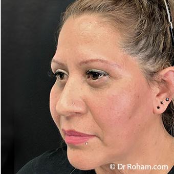 Blepharoplasty before and after - after