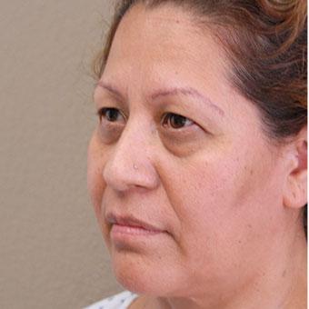 Blepharoplasty before and after - before