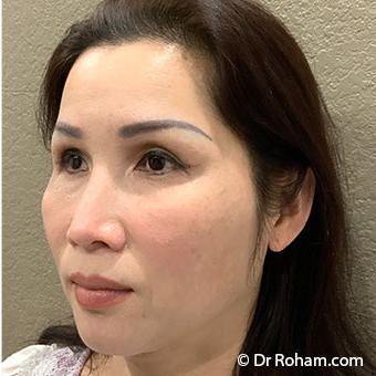 Blepharoplasty before and after - after