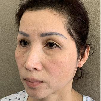 Blepharoplasty before and after - before