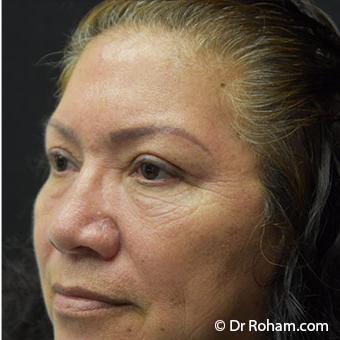 Blepharoplasty before and after - after