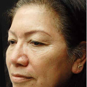 Blepharoplasty before and after - before