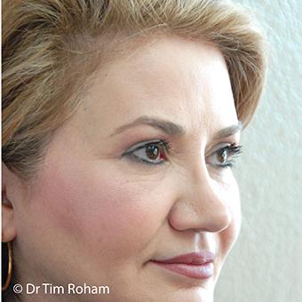 Blepharoplasty before and after - after