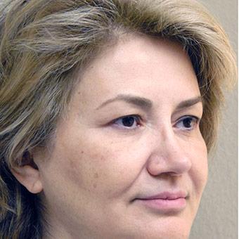 Blepharoplasty before and after - before