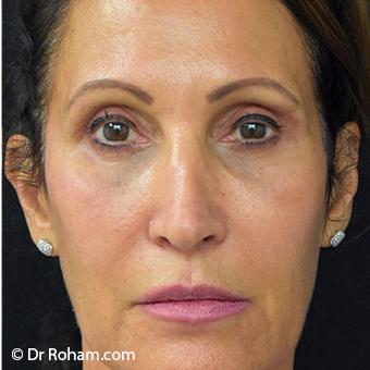 Blepharoplasty before and after - after
