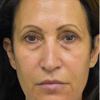 Blepharoplasty before and after - before