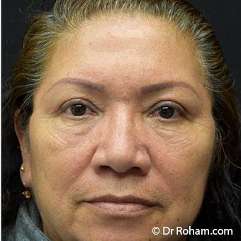 Blepharoplasty before and after - after