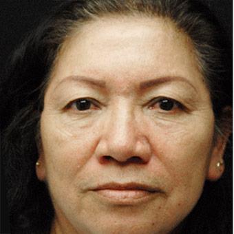 Blepharoplasty before and after - before