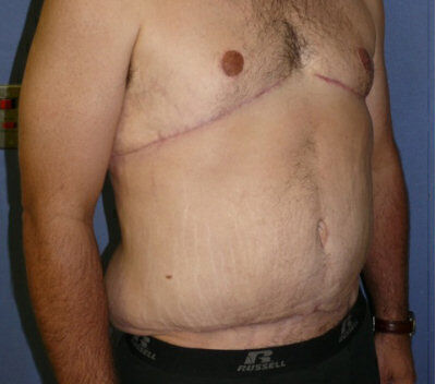 Body Contouring before and after - after