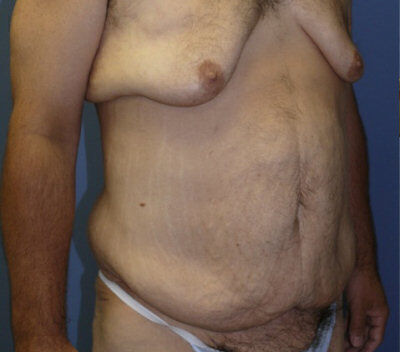 Body Contouring before and after - before
