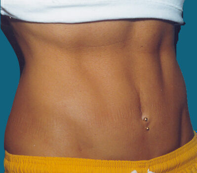 Abdominoplasty before and after - after