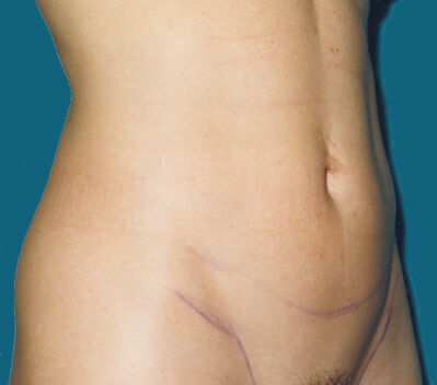 Abdominoplasty before and after - before