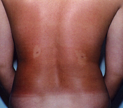 Liposuction before and after - after