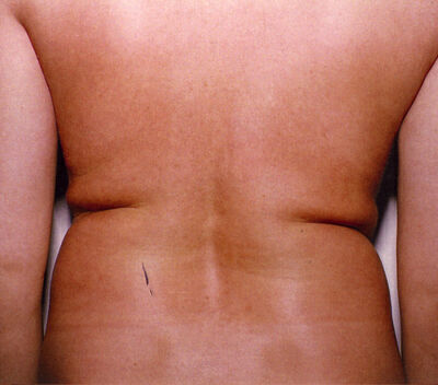 Liposuction before and after - before
