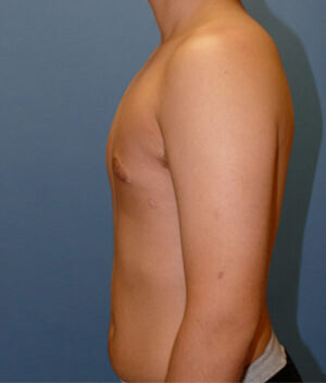 Liposuction before and after - after