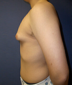 Liposuction before and after - before