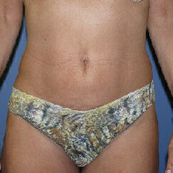 Liposuction before and after - after