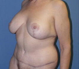 Body Contouring before and after - after
