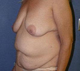 Body Contouring before and after - before