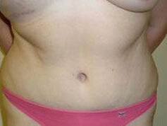 Abdominoplasty before and after - after