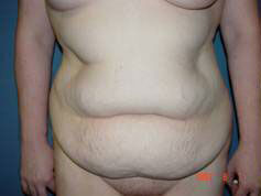 Abdominoplasty before and after - before