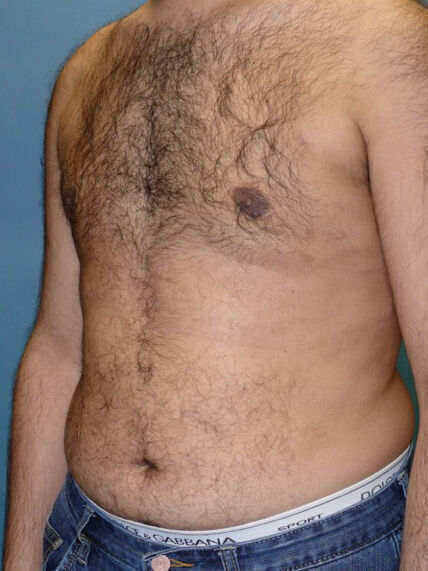 Liposuction before and after - after