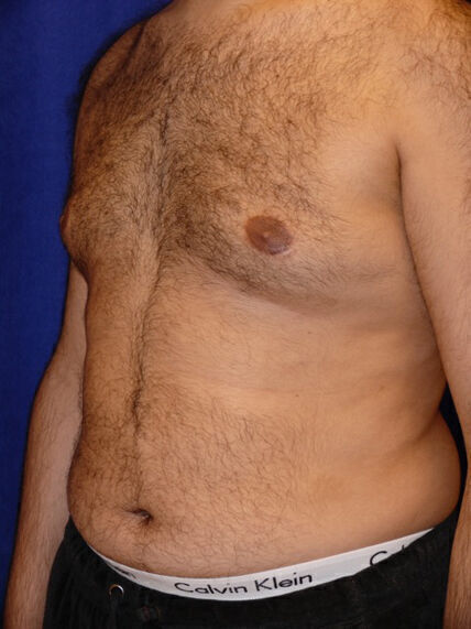 Liposuction before and after - before