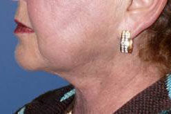 Liposuction before and after - after