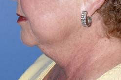 Liposuction before and after - before