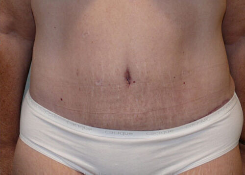 Body Contouring before and after - after