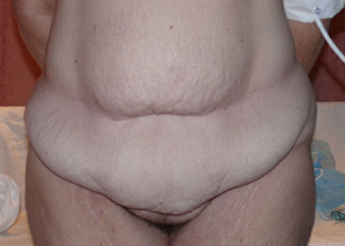 Body Contouring before and after - before