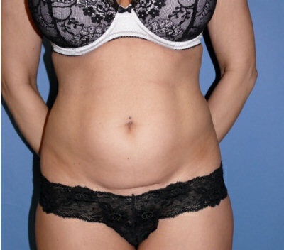 Abdominoplasty before and after - before