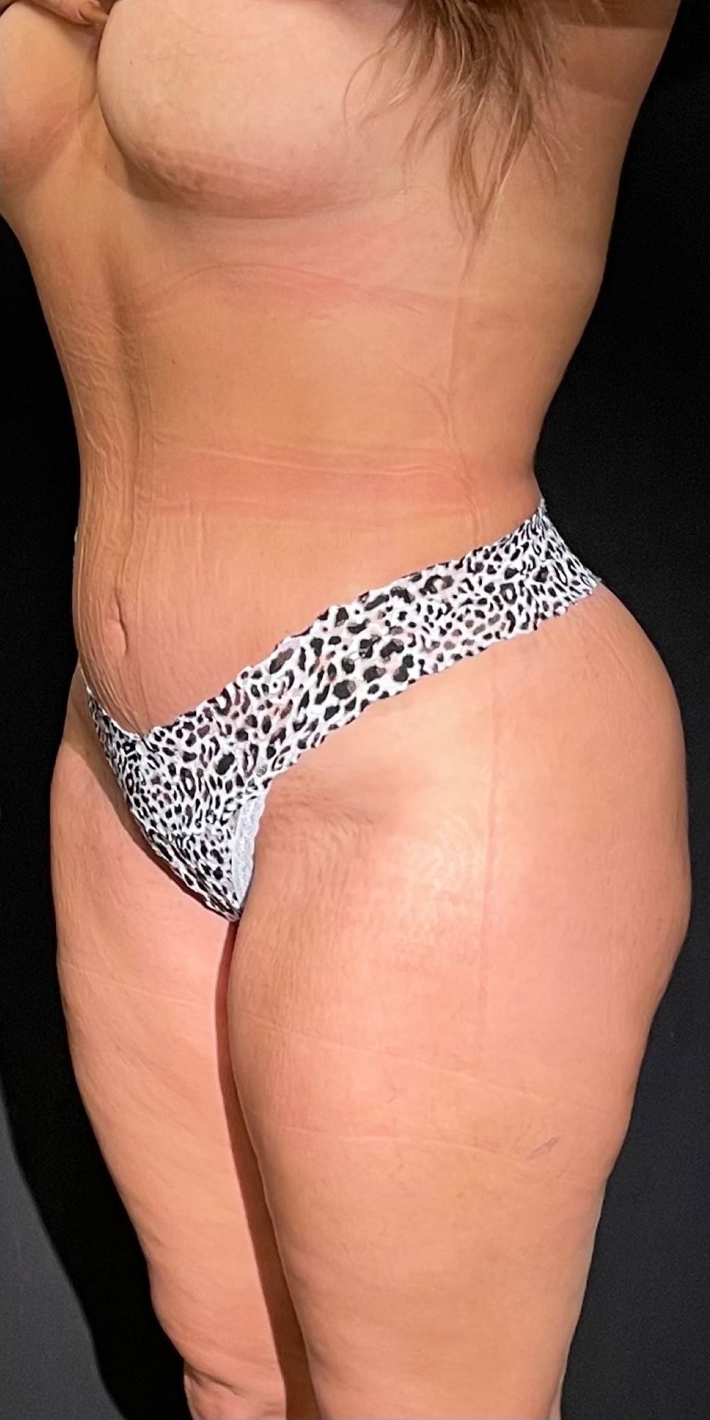 Brazilian Butt Lift before and after - after