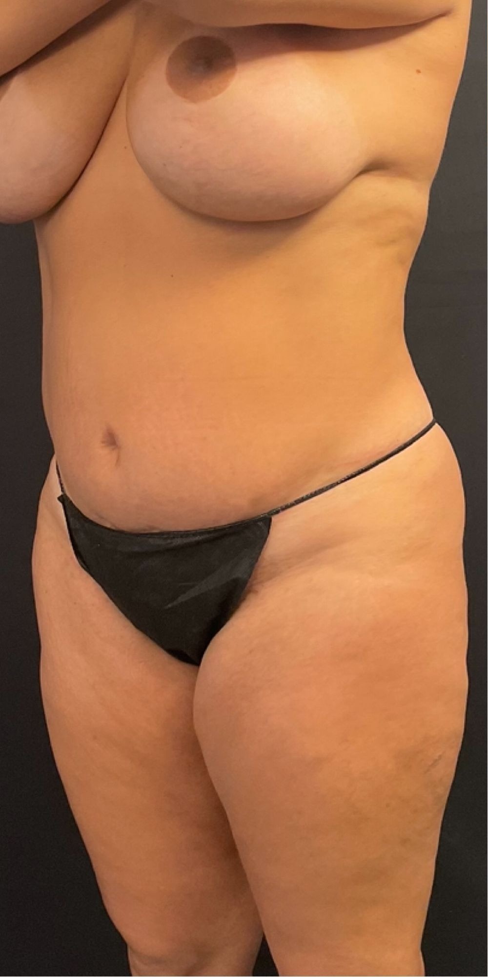 Brazilian Butt Lift before and after - before
