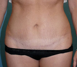 Abdominoplasty before and after - after